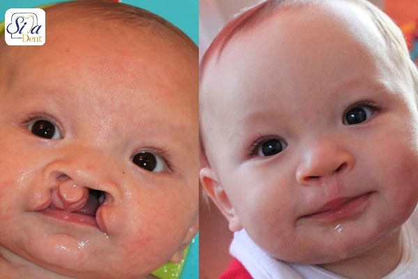 cleft-lip-cleft-palate