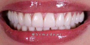 after smile correction ceramic veneer