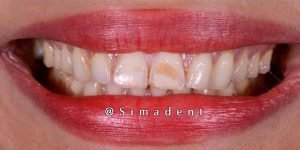 Before smile correction ceramic veneer