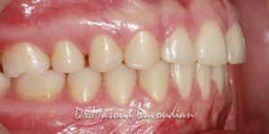 عکس ارتودنسی : درمان دندان‌های فاصله دار جانب