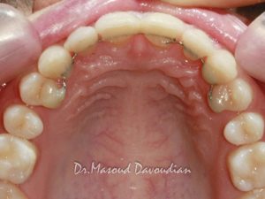 عکس ارتودنسی : درمان دندان‌های فاصله دار داخلی