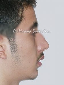 عکس ارتودنسی : ارتودنسی دیپ بایت کلی