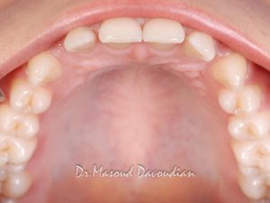 عکس ارتودنسی : دندان‌های فاصله دار داخل