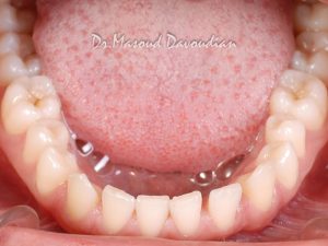عکس ارتودنسی : دندان‌های فاصله دار رو به رو