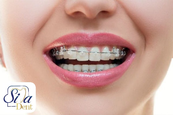 روش های ارتودنسی در بزرگسالان