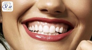 لبخند لثه ای