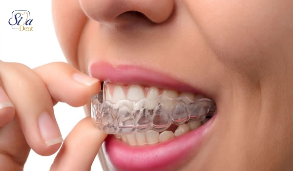 تفاوت ارتودنسی و لمینت دندان در هزینه