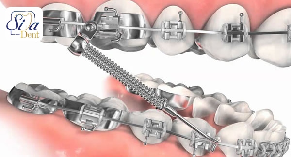 what is orthodontic bands