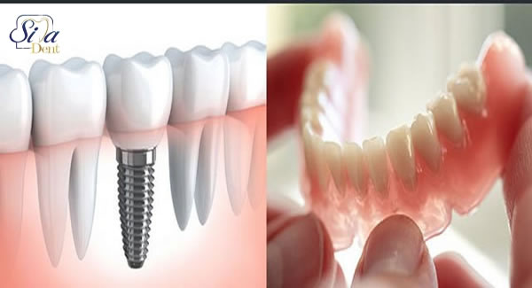کاشت دندان بهتر است یا دندان مصنوعی