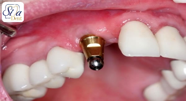 dental implant price