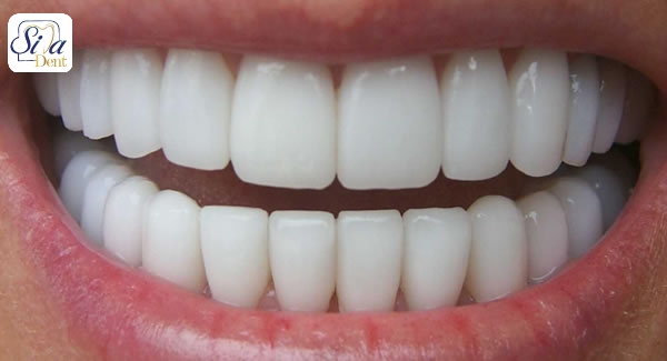 انواع روکش دندان براساس جنس