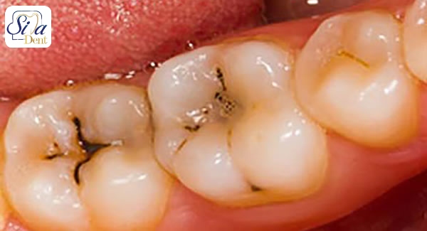 جلوگیری از آسیب مینای دندان
