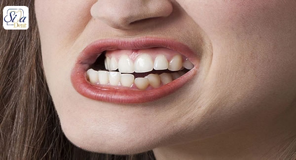 دندان قروچه و خرابی دندان
