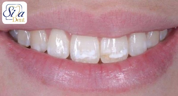 علل تغییر رنگ دندان ها
