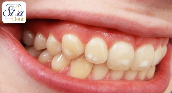 علل تغییر رنگ دندان ها