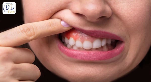 روش های پیشگیری از آبسه دندان