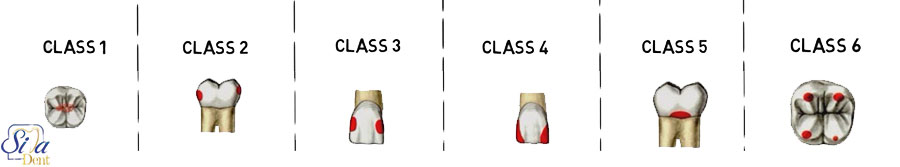 انواع سطوح و کلاس‌های پر کردن دندان