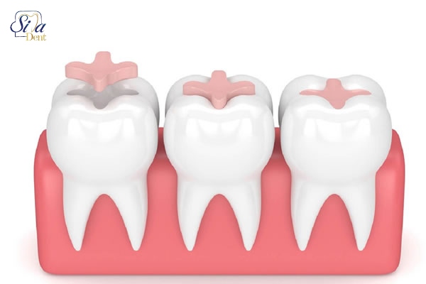 مراحل استفاده از اینله و انله دندان