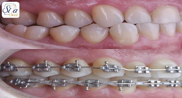 درمان ارتودنسی دندان نیش
