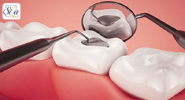 انواع روش های پرکردگی دندان پوسیده