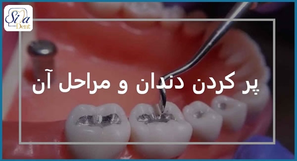 مراحل پر کردن دندان پوسیده