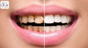 تاثیر ایمپلنت بر پوسیدگی دندان ها