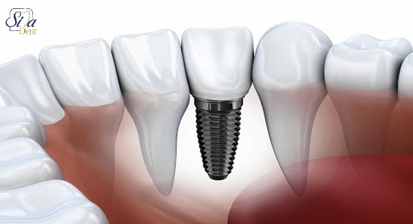 تعریفی از ایمپلنت دندان