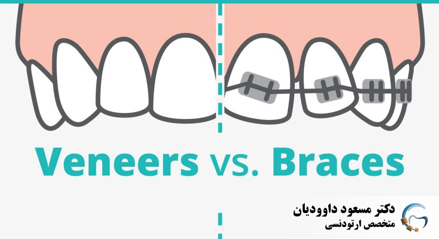 مقایسه ارتودنسی و لمینیت