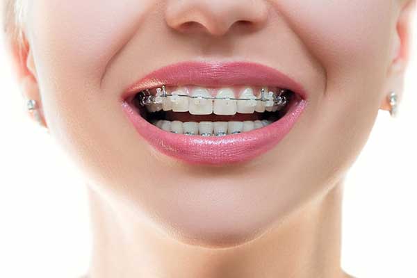 درمان ارتودنسی تک دندان