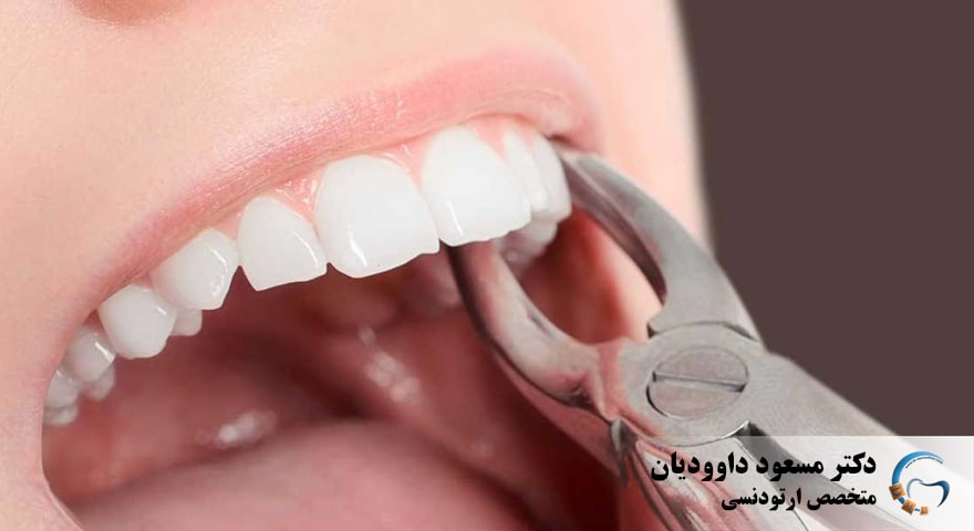کشیدن دندان و ارتودنسی