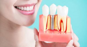 طول عمر ایمپلنت دندان یا کاشت دندان