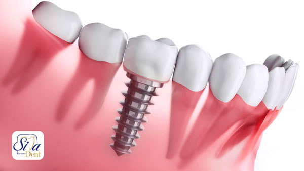 تا چند سال بعد از کشیدن دندان می‌توان ایمپلنت کرد؟