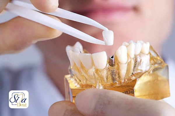 تا چند سال بعد از کشیدن دندان می‌توان ایمپلنت کرد؟