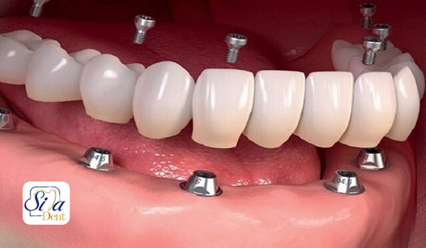 آیا همه دندان ها را می‌توان ایمپلنت کرد؟