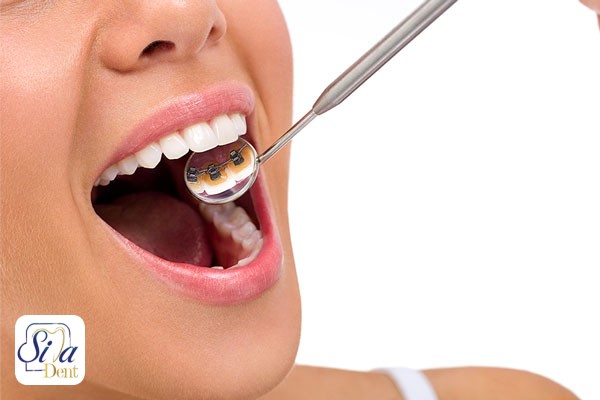 ارتودنسی از پشت دندان