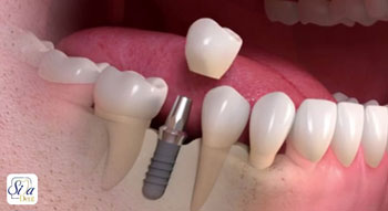 ایمپلنت دندان چقدر طول می‌کشد؟