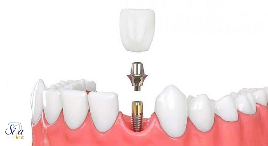 ایمپلنت دندان نیش