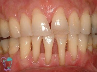 Gingival resorption 