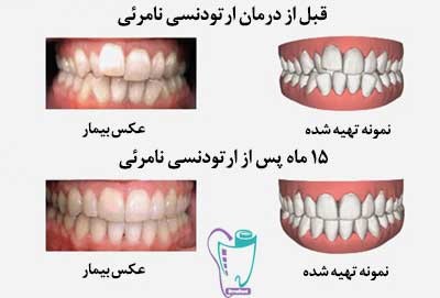Invisalign