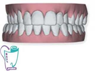 Invisalign