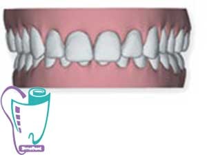 Invisalign