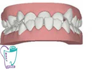 Invisalign