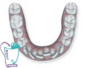 Invisalign