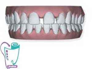 Invisalign