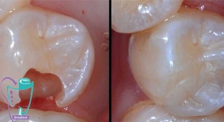 Tooth decay
