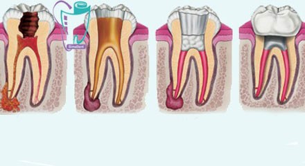 Tooth decay