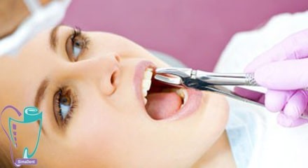 Tooth decay
