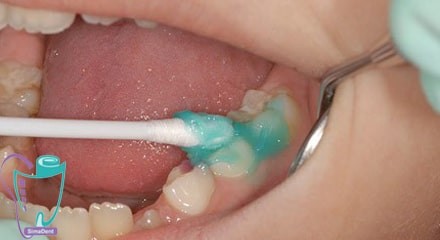 Tooth decay