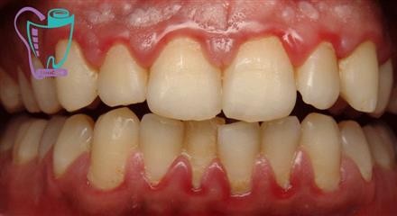 Bad Breath