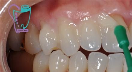 Dental sensitivity